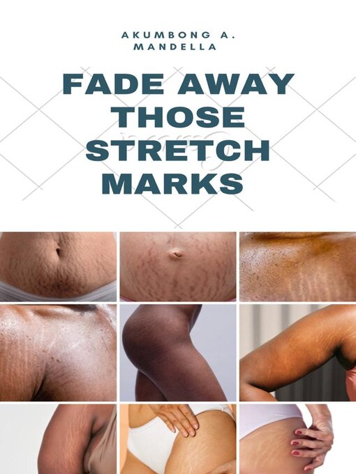 Title details for FADE AWAY THOSE STRETCH MARKS by Akumbong A.  Mandella - Available